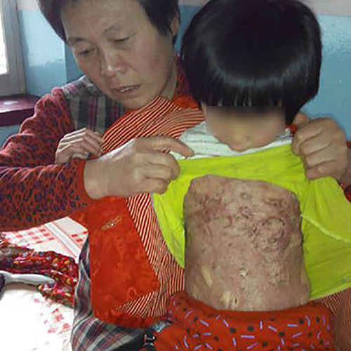 4歲女童王妤心不慎被爐上的開(kāi)水嚴(yán)重燙傷，受傷面積達(dá)40%
